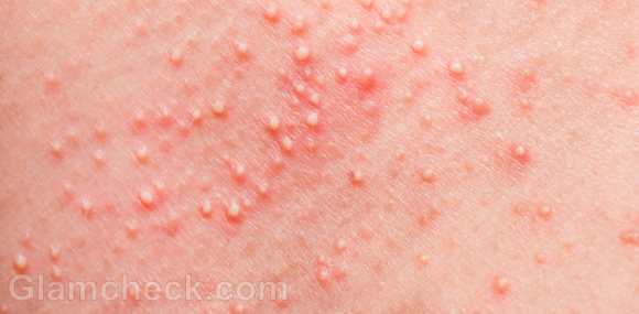 Regular heat rash has some common symptoms that are easily 