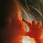 Surgical abortion