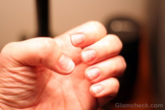 Cracked Nails : Causes, Symptoms & Treatment